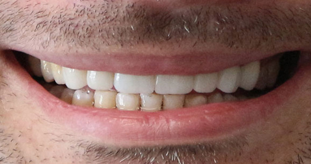 Dental Implants Houston Katy 77494 All on 4 Dental Implants