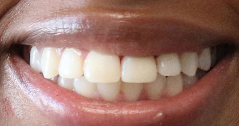 Dental Implants Houston Katy 77494 All on 4 Dental Implants